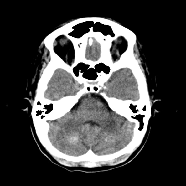 File:Bilateral PCA territory infarction - different ages (Radiopaedia 46200-50591 Axial non-contrast 5).jpg