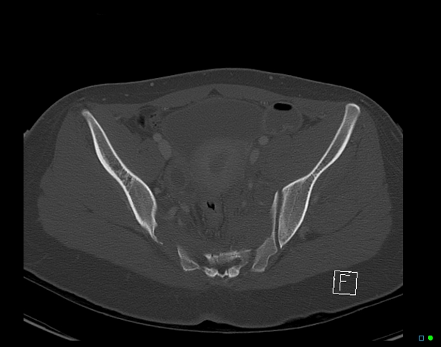 Bilateral acetabular fractures (Radiopaedia 79272-92308 Axial bone window 29).jpg