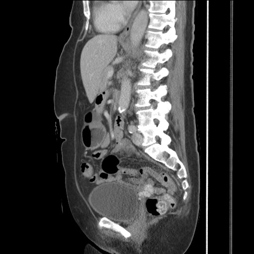 Bilateral adrenal granulocytic sarcomas (chloromas) (Radiopaedia 78375-91007 C 79).jpg