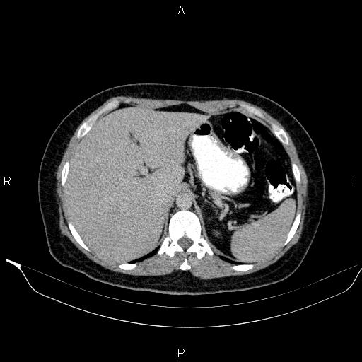 Bilateral adrenal myelolipoma (Radiopaedia 63058-71535 Axial C+ delayed 15).jpg