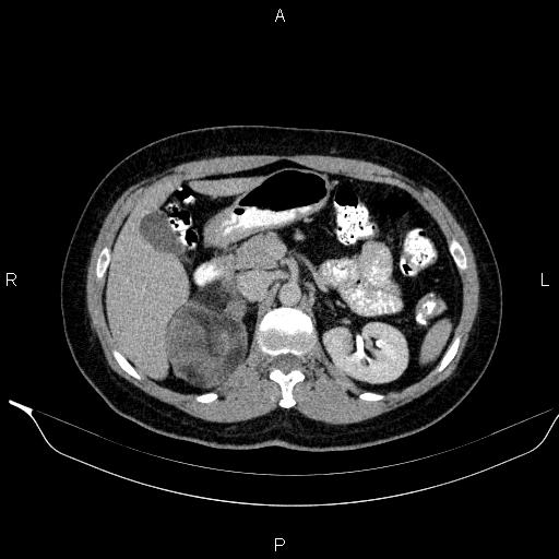 File:Bilateral adrenal myelolipoma (Radiopaedia 63058-71535 Axial C+ delayed 36).jpg
