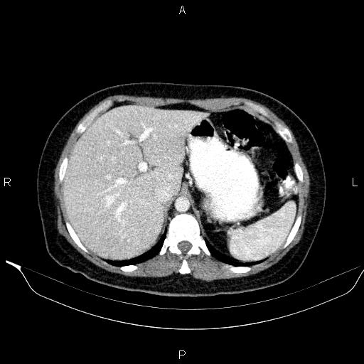 File:Bilateral adrenal myelolipoma (Radiopaedia 63058-71535 B 35).jpg
