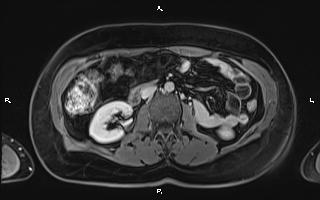 Bilateral adrenal myelolipoma (Radiopaedia 63058-71537 H 56).jpg