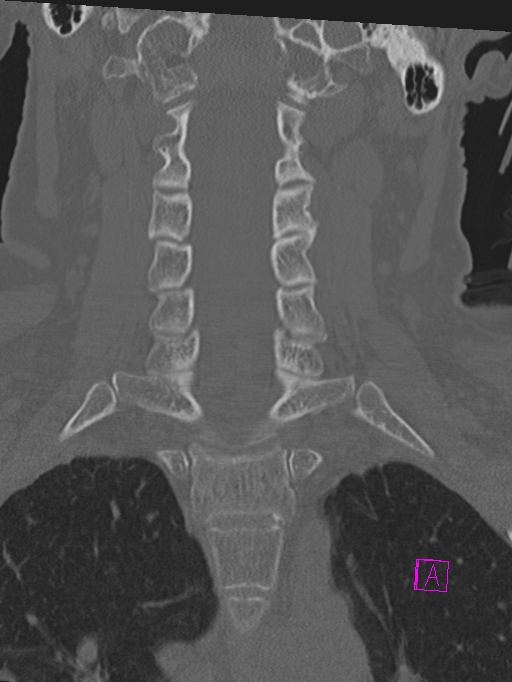 Bilateral atlanto-occipital assimilation (Radiopaedia 28350-28603 Coronal bone window 21).jpg