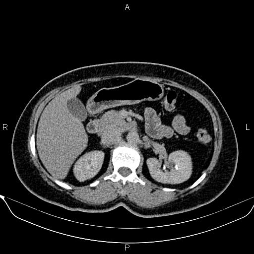 Bilateral benign adrenal adenomas (Radiopaedia 86912-103124 Axial C+ delayed 46).jpg