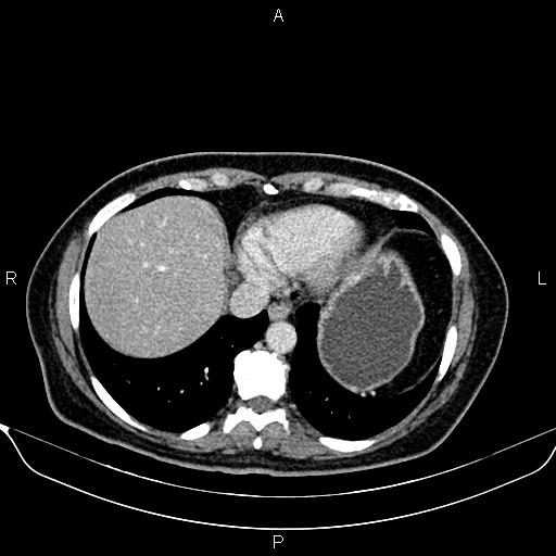 Bilateral benign adrenal adenomas (Radiopaedia 86912-103124 B 15).jpg
