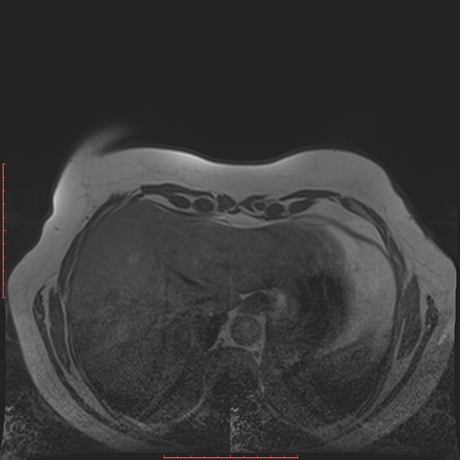 File:Bilateral breast implant rupture (Radiopaedia 24761-25027 T1 35).jpg