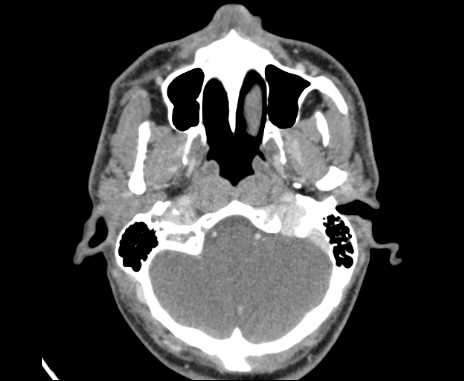 Bilateral carotid body tumors (Radiopaedia 61841-69870 Axial Post contrast 9).jpg