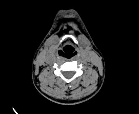 Bilateral carotid body tumors (Radiopaedia 61841-69870 Axial non-contrast 58).jpg