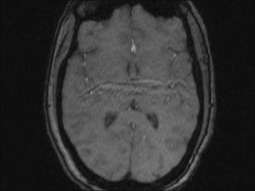 Bilateral carotid body tumors and right glomus jugulare tumor (Radiopaedia 20024-20060 Axial MRA 352).jpg