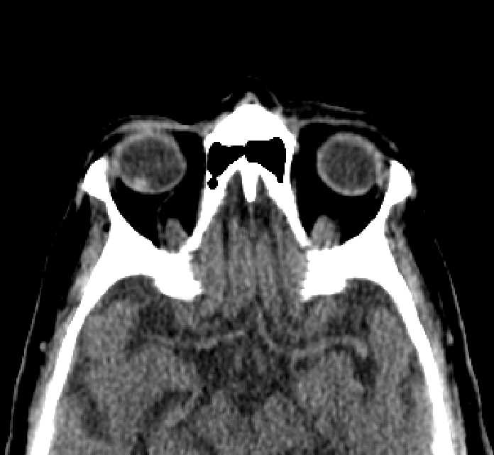 Bilateral ectopia lentis (Radiopaedia 89889-107013 Axial non-contrast 24).jpg