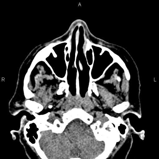 Bilateral enlargement of lacrimal glands - sarcoidosis (Radiopaedia 62627-70921 Axial non-contrast 15).jpg