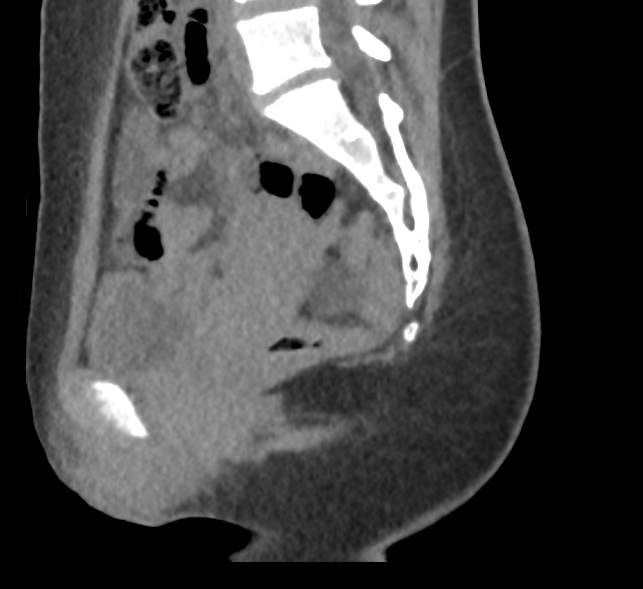File:Bilateral mature cystic ovarian teratoma (Radiopaedia 88821-105592 D 29).jpg