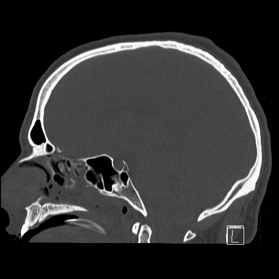 Bilateral occipital condyle fracture (type 2) (Radiopaedia 87675-104089 Sagittal bone window 57).jpg