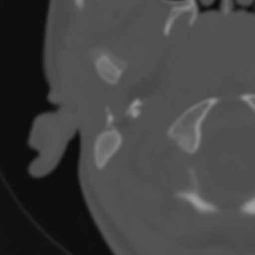 Bilateral otosclerosis (Radiopaedia 57237-64157 B 6).jpg