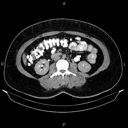 Bilateral ovarian dermoid cysts (Radiopaedia 85785-101603 Axial C+ delayed 36).jpg
