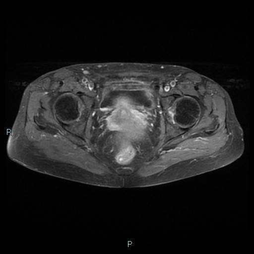 File:Bilateral ovarian fibroma (Radiopaedia 44568-48293 Axial T1 C+ fat sat 20).jpg