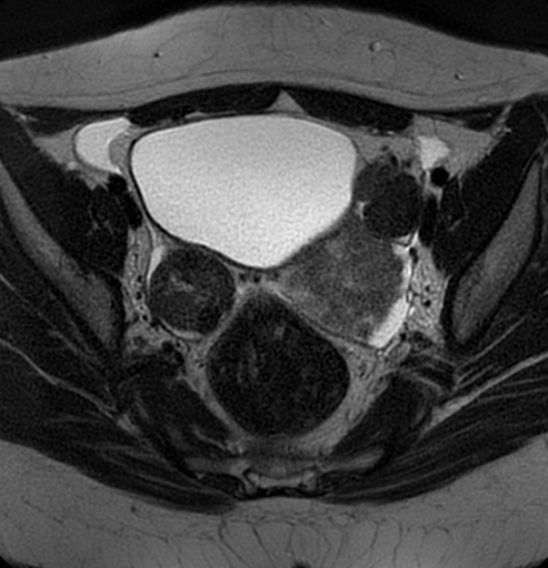 File:Bilateral ovarian fibrothecomas - adolescent (Radiopaedia 86604-102707 Axial T2 22).jpg