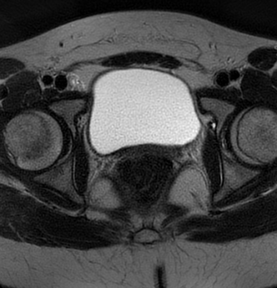 File:Bilateral ovarian fibrothecomas - adolescent (Radiopaedia 86604-102707 Axial T2 36).jpg