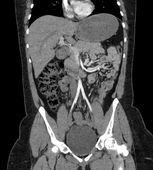 Bilateral ovarian mature cystic teratomas (Radiopaedia 79373-92457 B 26).jpg