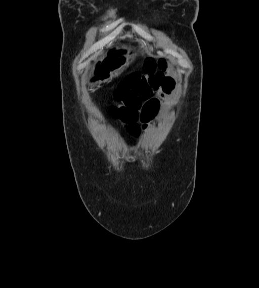 File:Bilateral ovarian mature cystic teratomas (Radiopaedia 79373-92457 B 4).jpg
