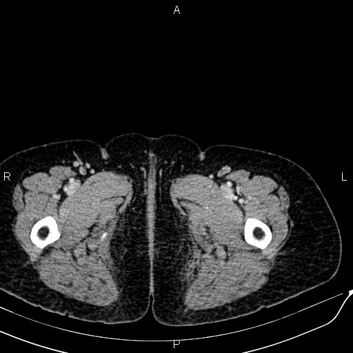 Bilateral ovarian serous cystadenocarcinoma (Radiopaedia 86062-101989 B 113).jpg