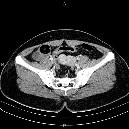 Bilateral ovarian teratoma (Radiopaedia 83131-97503 Axial With contrast 30).jpg