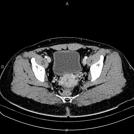 Bilateral ovarian teratoma (Radiopaedia 83131-97503 Axial With contrast 53).jpg