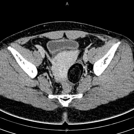 Bilateral ovarian teratoma (Radiopaedia 83131-97503 B 45).jpg