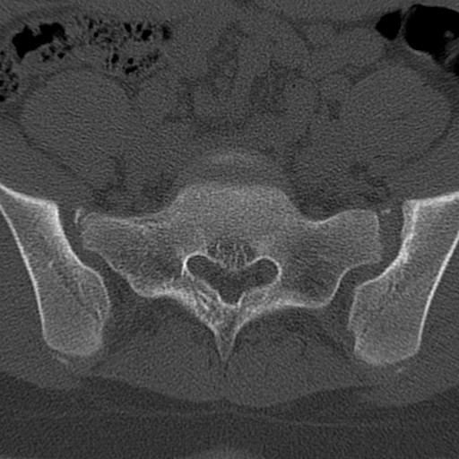 Bilateral pars defect (Radiopaedia 26691-26846 Axial bone window 79).jpg