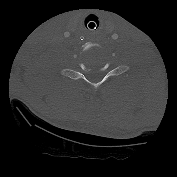 File:Bilateral perched facets with cord injury (Radiopaedia 45587-49713 Axial bone window 80).jpg