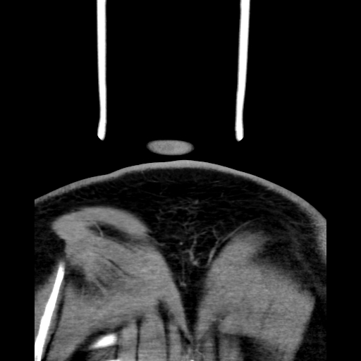 Bilateral peritonsillar abscess (Radiopaedia 85065-100610 Coronal 76).jpg