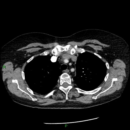 Bilateral pulmonary emboli (Radiopaedia 32700-33669 Axial C+ CTPA 25).jpg