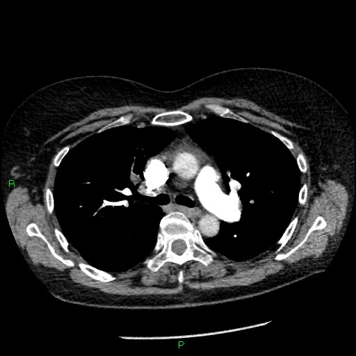 Bilateral pulmonary emboli (Radiopaedia 32700-33669 Axial C+ CTPA 42).jpg