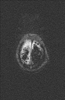 Bilateral subdural hemorrhage and parietal skull fracture (Radiopaedia 26058-26190 Axial SWI 78).png