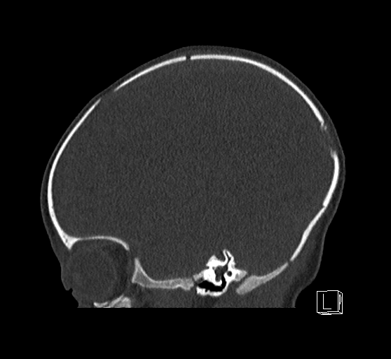 Bilateral subdural hemorrhage and parietal skull fracture (Radiopaedia 26058-26192 Sagittal bone window 69).png