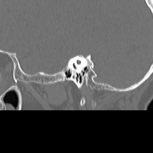 Bilateral tympanoplasty (Radiopaedia 16947-16664 Sagittal bone window 45).jpg