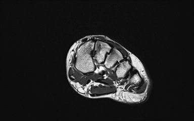 Bipartite hallux sesamoid diastasis (Radiopaedia 77133-89109 Coronal PD 5).jpg