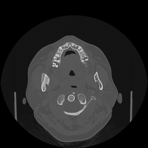 File:Bisphosphonate-related osteonecrosis of the jaw (Radiopaedia 71324-81642 Axial bone window 100).jpg