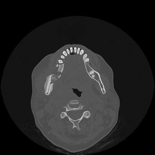 File:Bisphosphonate-related osteonecrosis of the jaw (Radiopaedia 71324-81642 Axial bone window 64).jpg