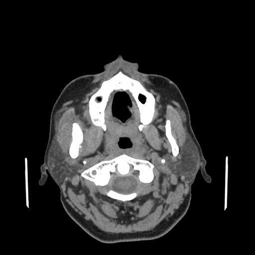 Bisphosphonate-related osteonecrosis of the jaw (Radiopaedia 71324-81642 non-contrast 112).jpg