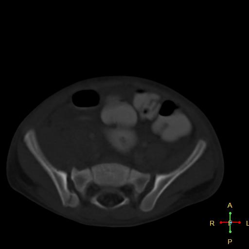 File:Blunt abdominal trauma (Radiopaedia 24780-25044 Axial bone window 8).jpg