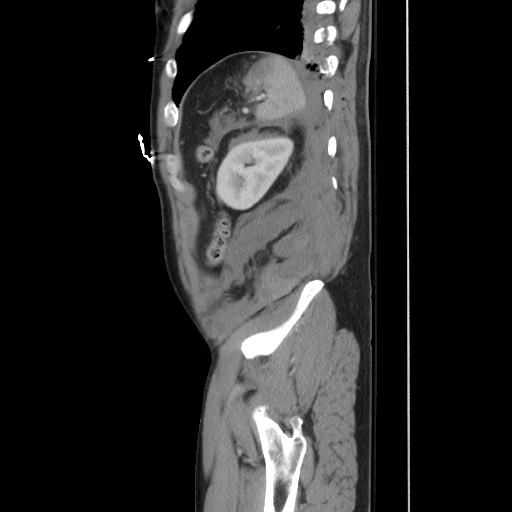 File:Blunt abdominal trauma with solid organ and musculoskelatal injury with active extravasation (Radiopaedia 68364-77895 C 118).jpg