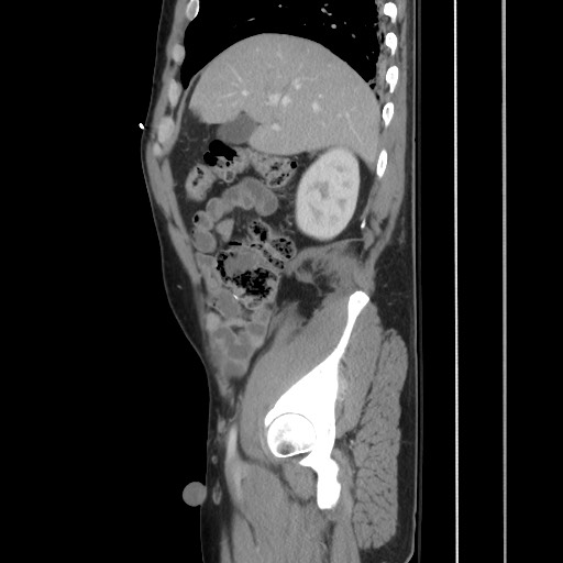 File:Blunt abdominal trauma with solid organ and musculoskelatal injury with active extravasation (Radiopaedia 68364-77895 C 46).jpg