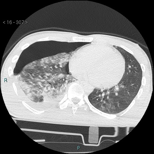Blunt chest trauma (Swiss cheese sign) (Radiopaedia 38519-40618 Axial lung window 50).jpg