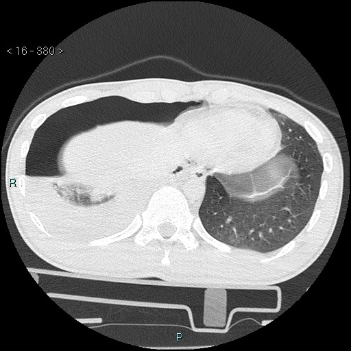 Blunt chest trauma (Swiss cheese sign) (Radiopaedia 38519-40618 Axial lung window 67).jpg