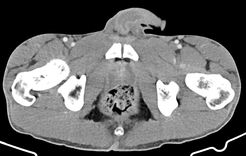 Blunt injury to the small bowel (Radiopaedia 74953-85987 A 196).jpg