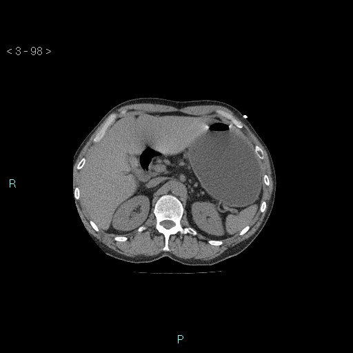 Boerhaave syndrome (Radiopaedia 27683-27897 Axial non-contrast 98).jpg