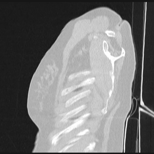 Boerhaave syndrome (Radiopaedia 45644-49799 Sagittal lung window 4).jpg