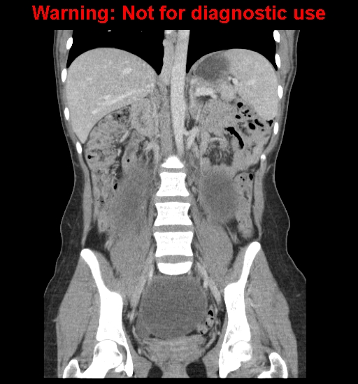 Borderline mucinous cystadenoma of ovary (Radiopaedia 25586-25767 B 40).jpg